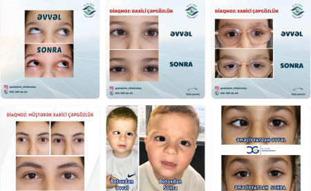 Göz Sağlamlığının Qoruyucusu: Dr. Günel Xalıqverdiyeva – Təcrübəli və Fədakar Oftalmoloq